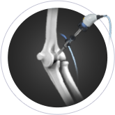 Elbow Arthroscopy