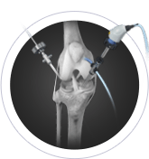 Knee Arthroscopy